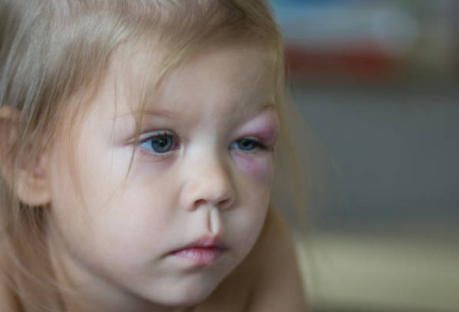 Lesiones oculares en niños