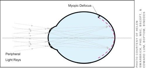control de la miopía